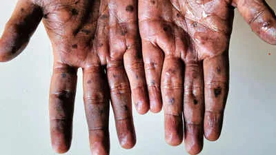 Mpox: Can Mpox become the new Covid? Here's how the infection is spreading  in the current outbreak | - Times of India