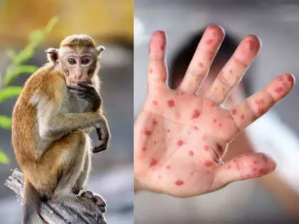 mpox virus: What is monkey pox? Has WHO declared it as a pandemic? Is it  worse than covid? - The Economic Times