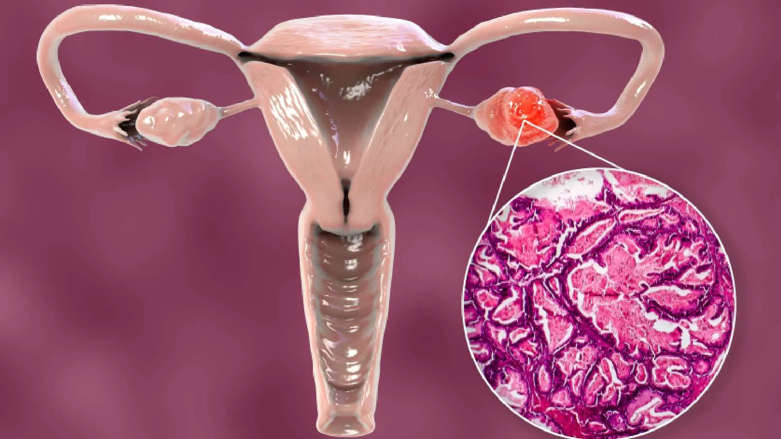 Ovarian Cancer - Symptoms, Types, Causes, Treatment & Prevention |  Healthshots