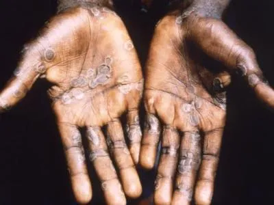 Mpox | CIDRAP
