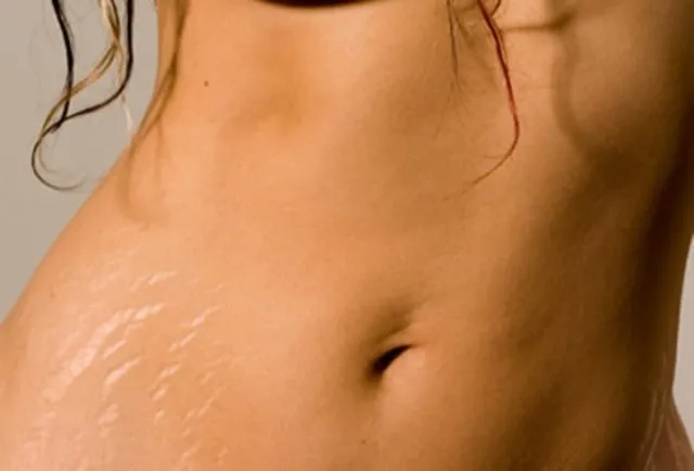 stretch-marks