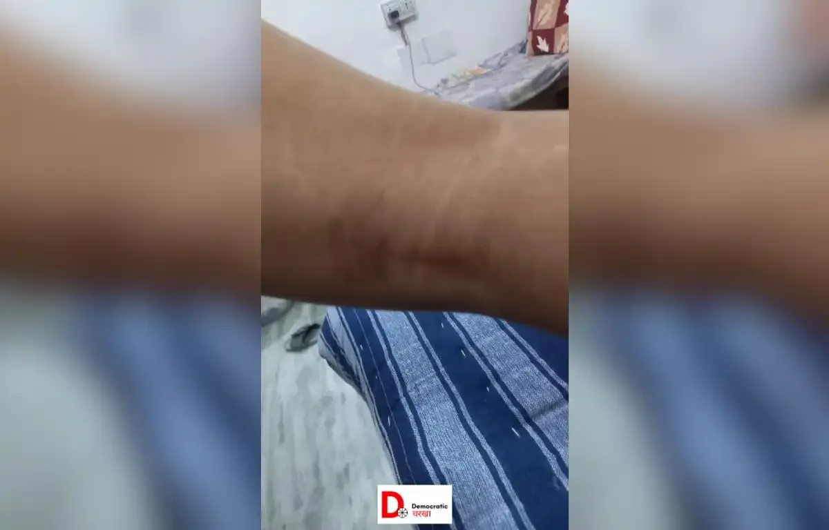 बंदरों के काटने के बाद कई बीमारियों का ख़तरा होता है 