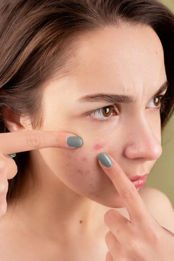 Adult Acne
