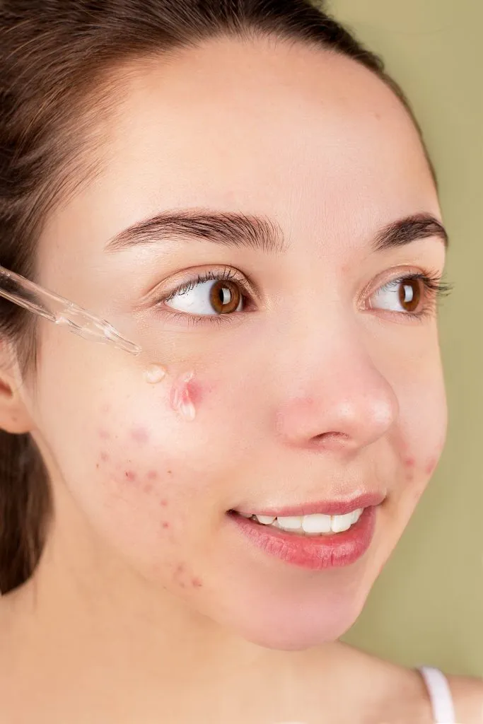 Adult Acne