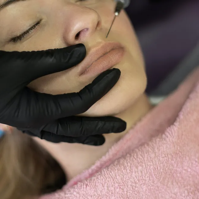Facial Fillers queries