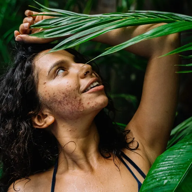 Adapalene for skin types
