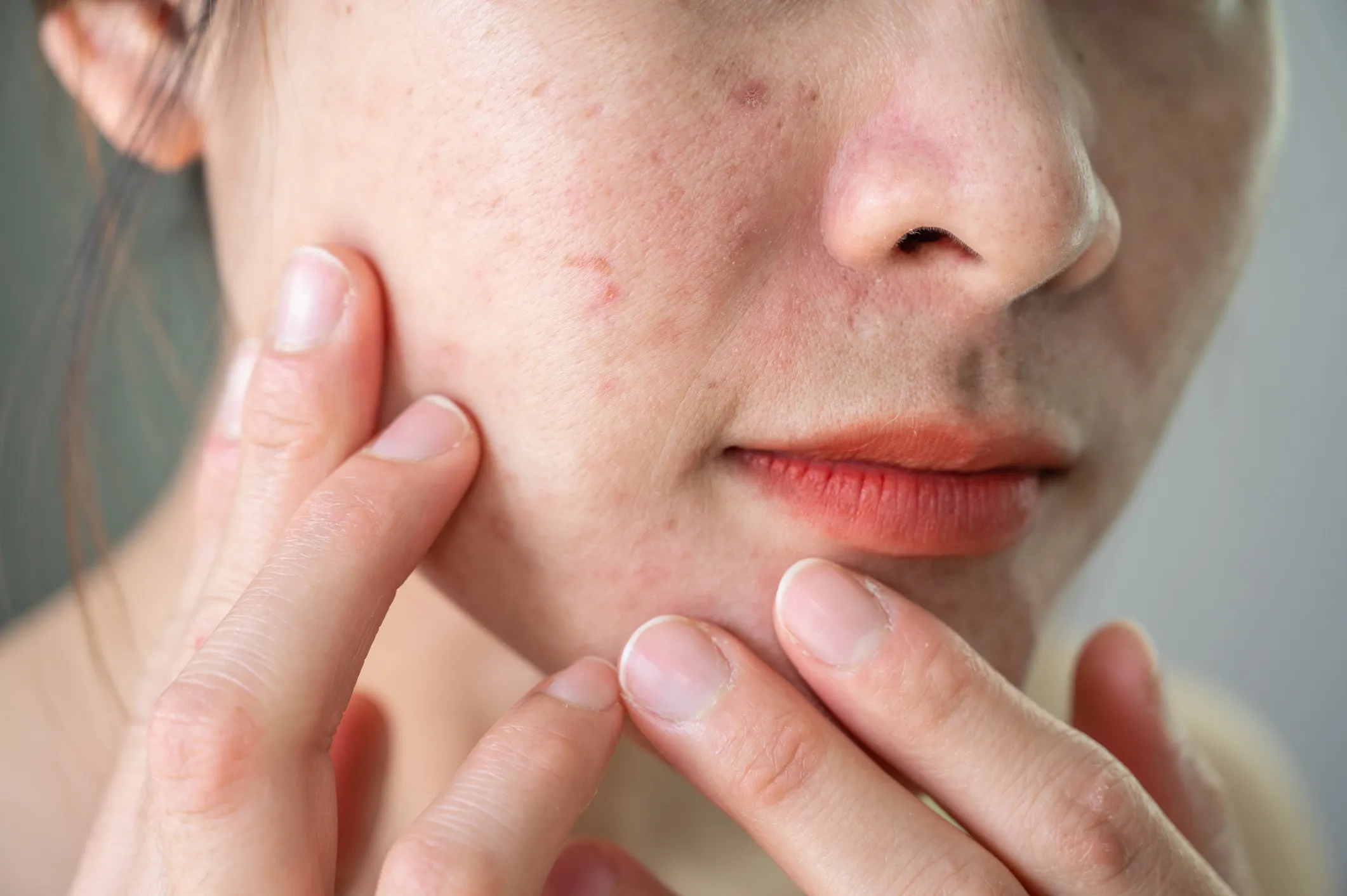 Psychodermatology