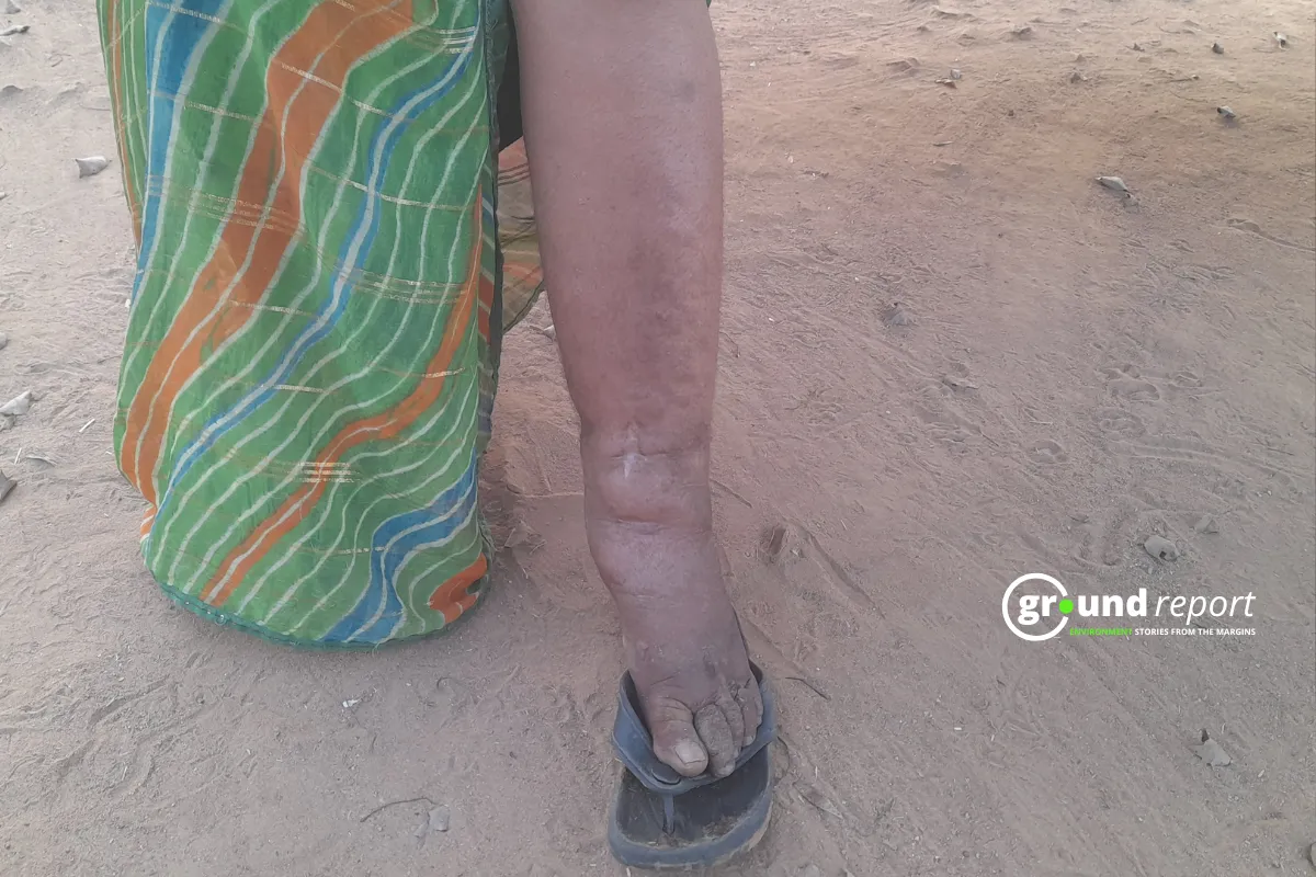 filariasis