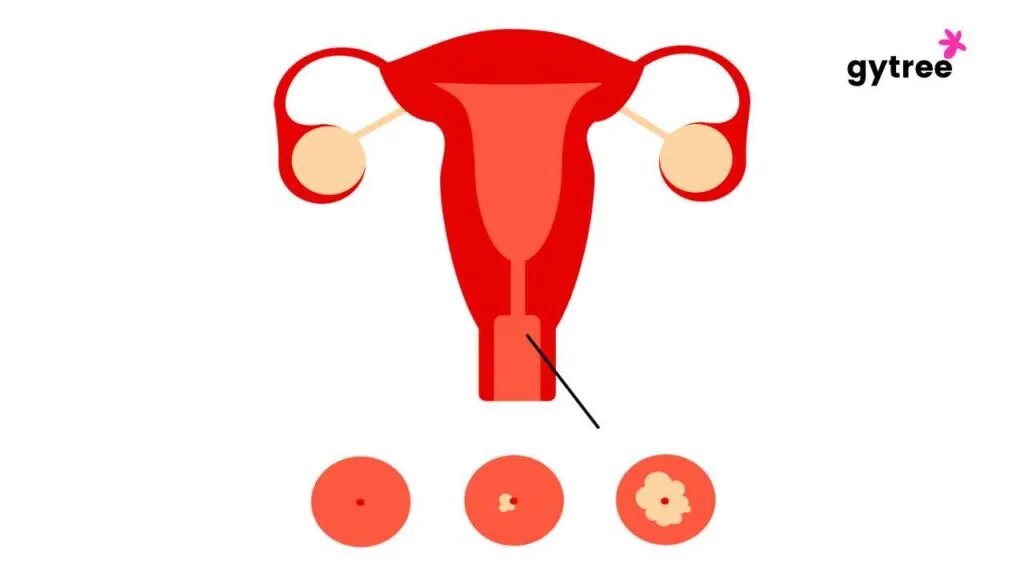 Diagnosis of Cervical Cancer