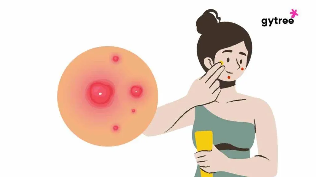 Stress and acne