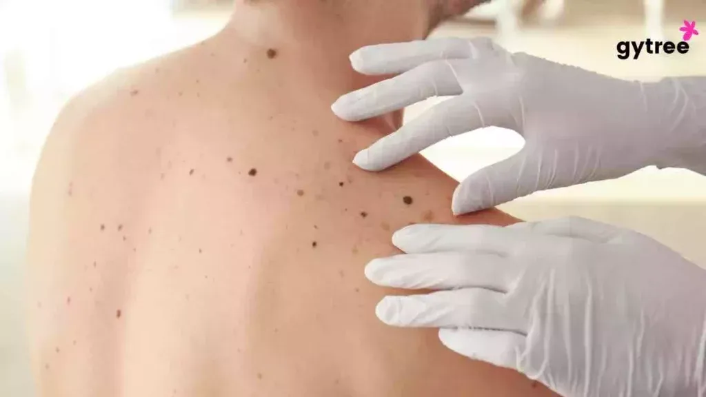 Black neck: Symptoms and treatment