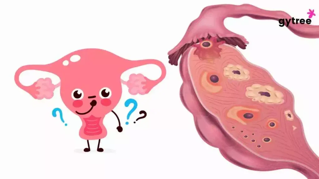 Hysterectomy: What happens to eggs after uterus is removed?
