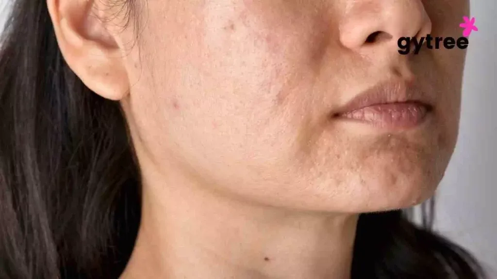 Skin Dullness: Causes and Home remedies