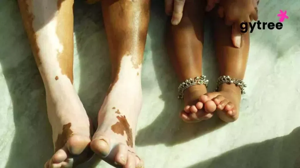 Vitiligo: Symptoms, Causes & Treatment