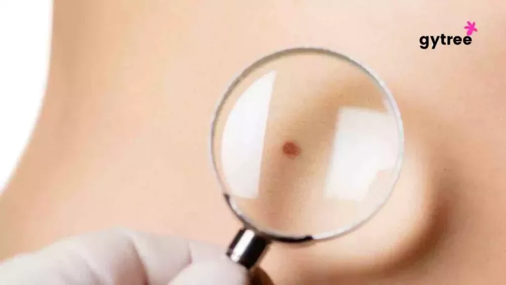 Moles: When to get concerned about them?