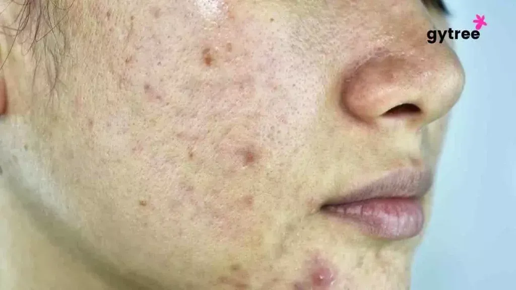 How to clear acne and pigmentation permanently?