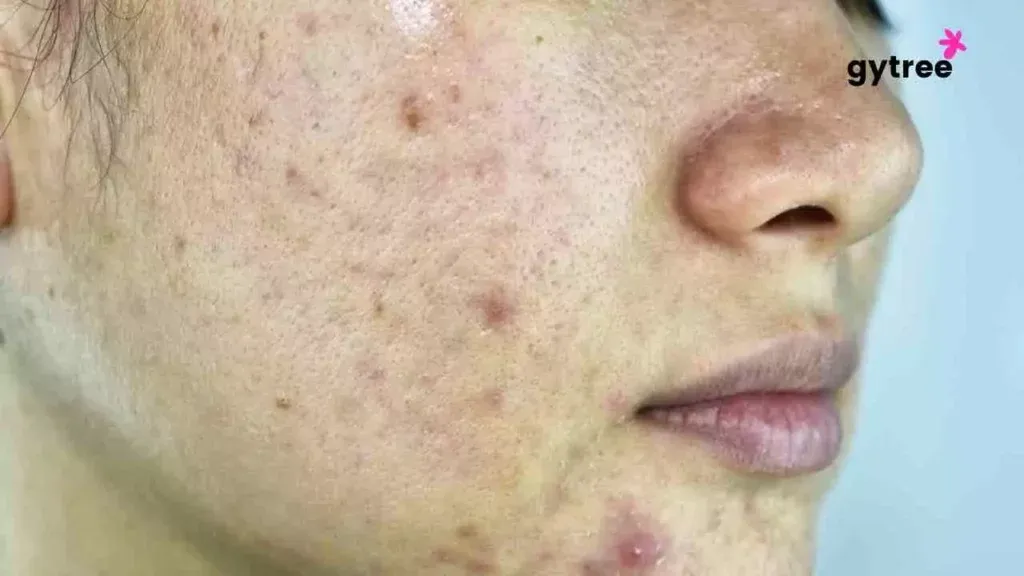 Acne and Pigmentation: 9 Effective ways to manage.