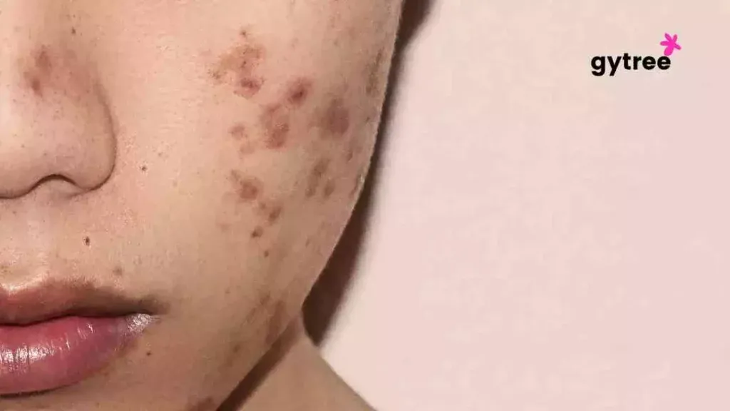 Is Pregnancy acne & pigmentation permanent?