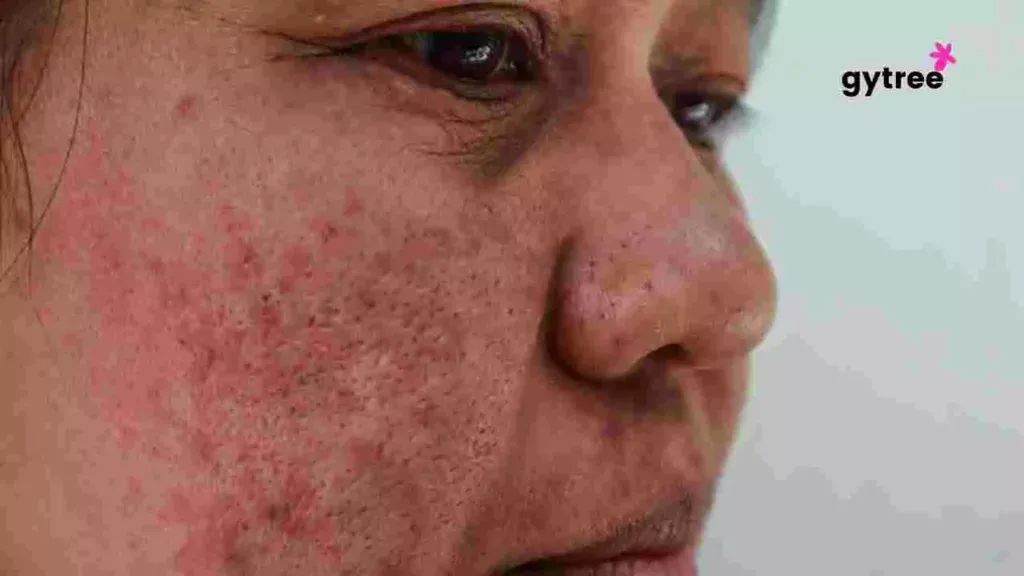 Kojic Acid: Unlock these 5 Benefits