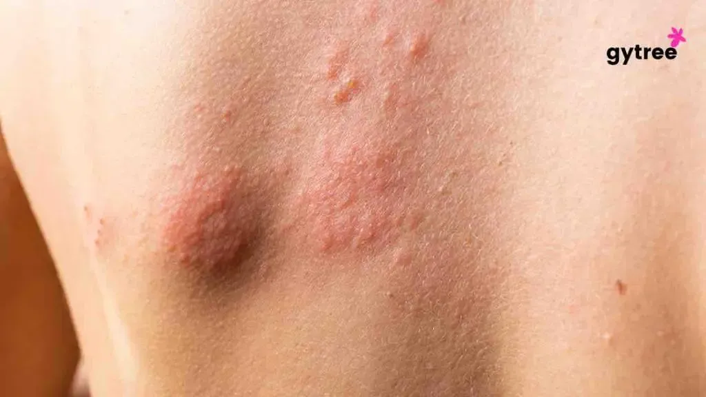 Redness Be Gone: Cure PAD Rashes and Find Relief in 10 Fruitful Ways