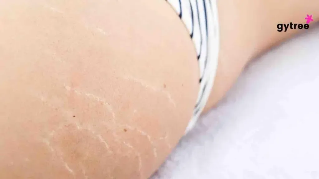 A Brief View at Stretch Marks in Women: Embrace Your Stripes in 10 Ways