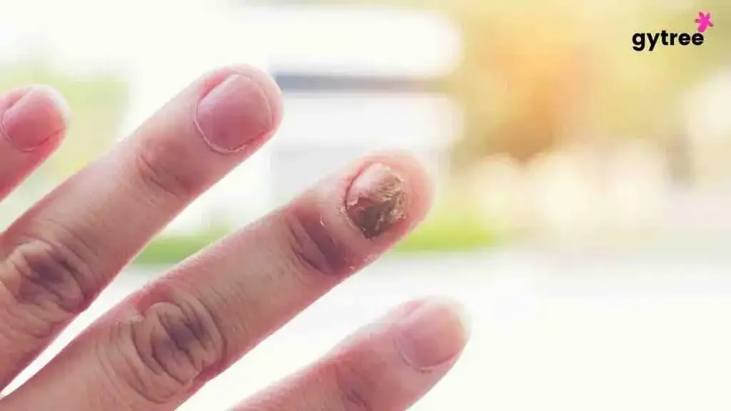 Understanding Onychomycosis in 6 Ways: The Battle Against Fungal Infection on Nails