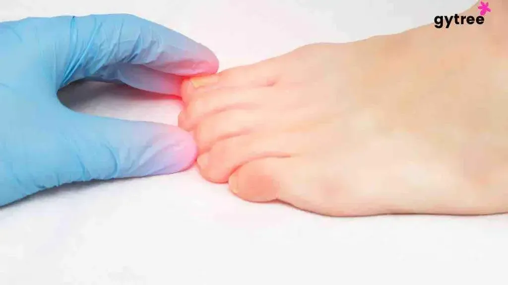 Understanding Onychomycosis in 6 Ways: The Battle Against Fungal Infection on Nails