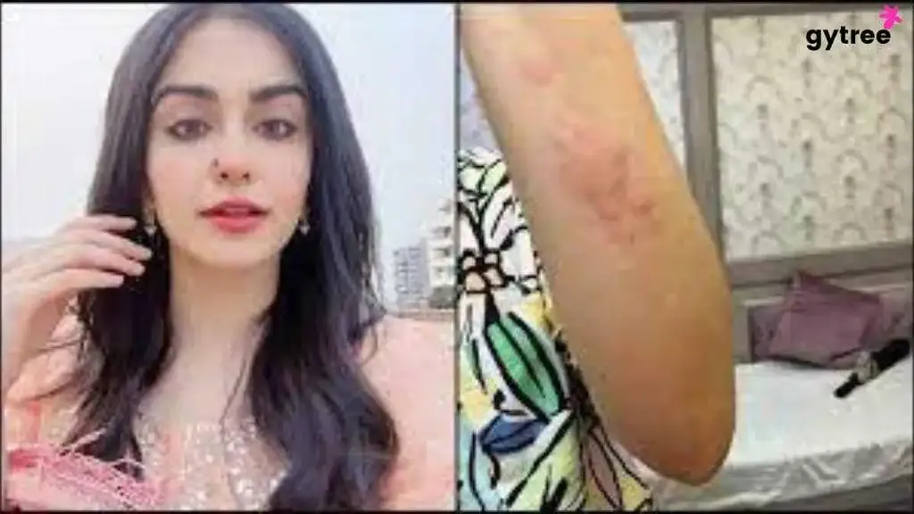Adah Sharma's Hives Skin Condition: Her Battle With The Disease