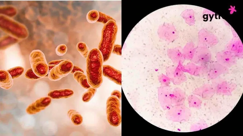 Cottage Cheese Vaginal Discharge Spotted? What to do about it?