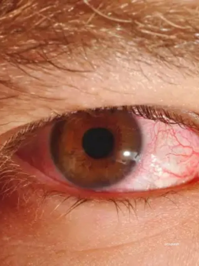 Monsoon Eye Health (unsplash)