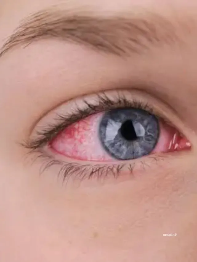 Monsoon Eye Health (unsplash)