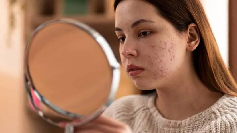 Got Oily Skin Here Are Five Foods You Must Include In Diet Or Your Lunch You Must Follow 
