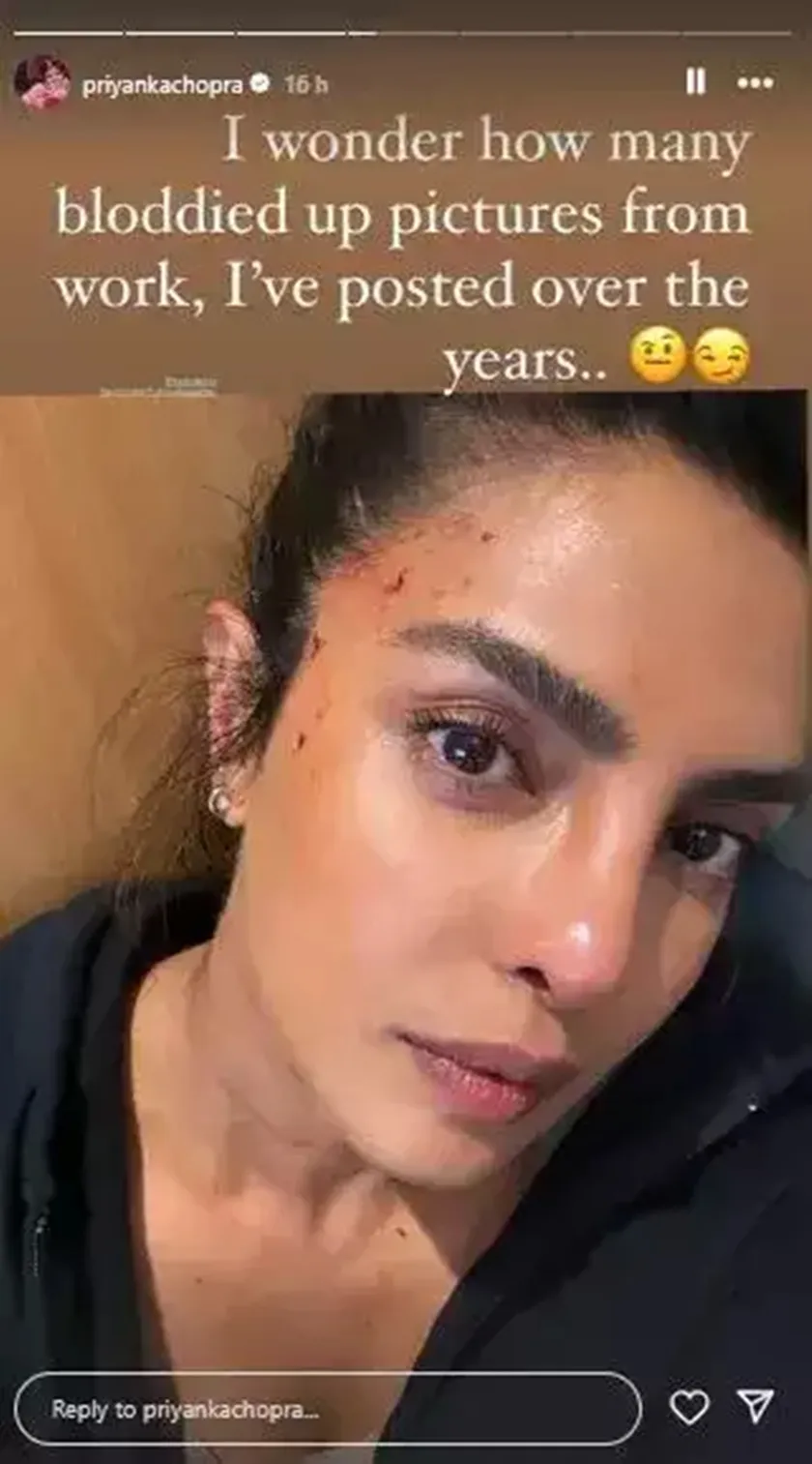  priyanka chopra, priyanka chopra bruise, priyanka chopra news, priyanka chopra bollywood, priyanka chopra update, priyanka chopra lifestyle, priyanka chopra injured, priyanka chopra entertainment news<br />
