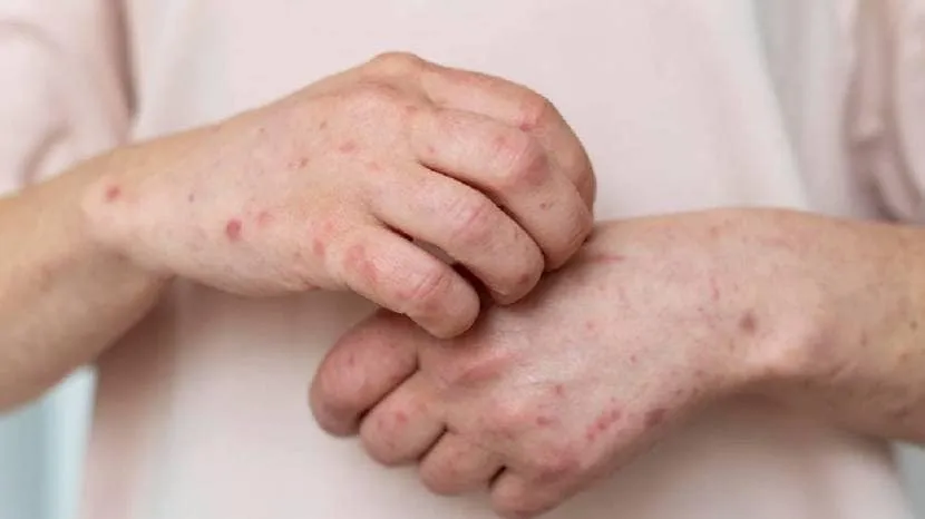 Dengue fever is quite common during the monsoon. Here are some prevention steps that can help you stay safe this season