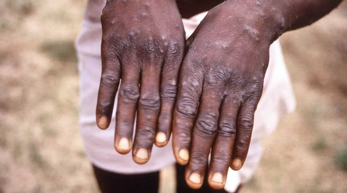 Monkeypox vs smallpox, Monkeypox symptoms, Monkeypox kerala, Monkeypox spread, Monkeypox virus, Monkeypox treatment, Monkeypox malayalam, Monkeypox symptoms malayalam, Monkeypox vaccine, കുരങ്ങ് പനി, കുരങ്ങ് പനി ലക്ഷണങ്ങള്‍, കുരങ്ങ് വസൂരി, കുരങ്ങ് പനിയുടെ ലക്ഷണം, കുരങ്ങ് പനി ചികിത്സ