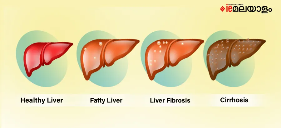 Liver disease, Dr. Harikumar Nair, IEmalayalam