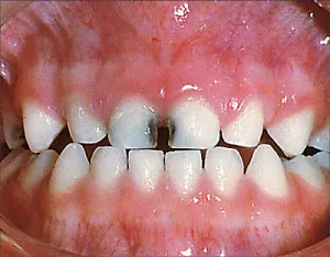 teeth florosis