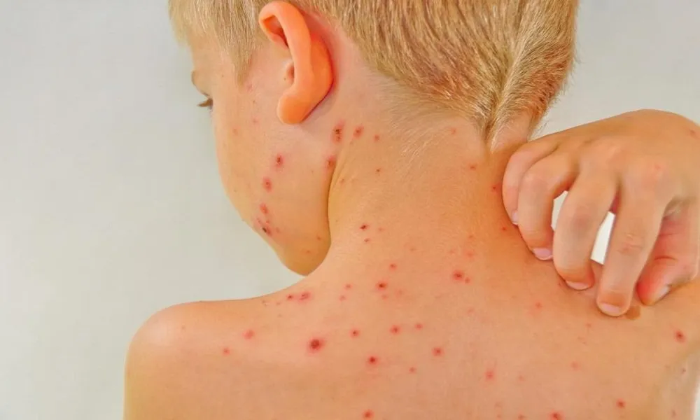 Chicken Pox in Children: Treatment and Prevention