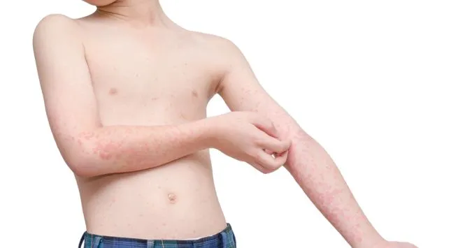 Chicken Pox in Children: Treatment and Prevention