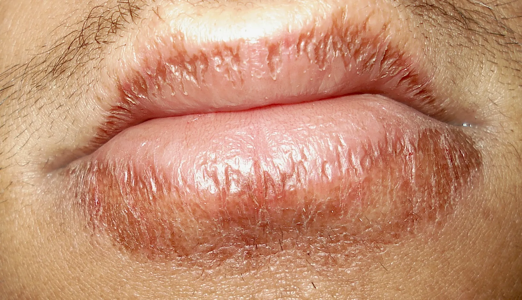 Chapped lips 