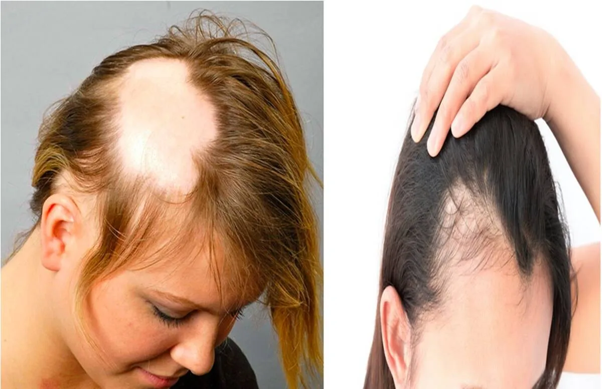 common mistakes of hairfall 