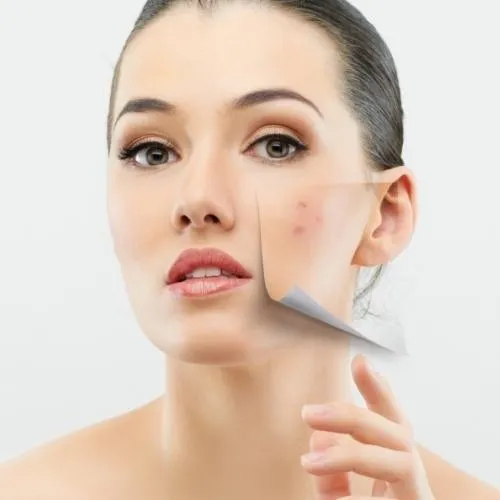 acne breakout