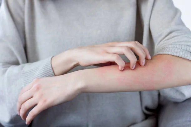 allergy 