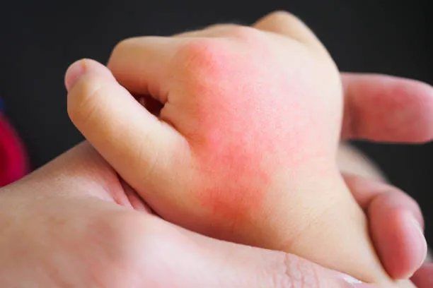 allergy