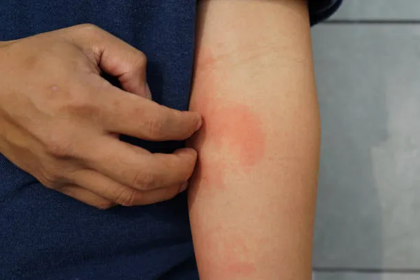  itching home remedies