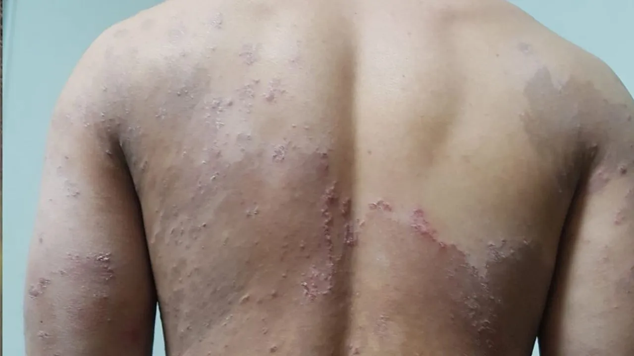 antifungal  