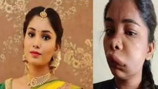 Kannada actress Swathi Sathish gets swollen face after root canal surgery, pictures go viral