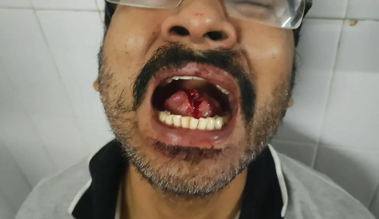 Kurnool District A wife who bit off her husband tongue for kissing her 
