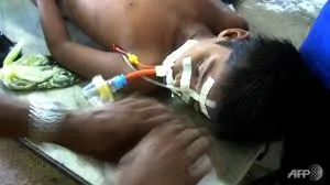 encephalitis