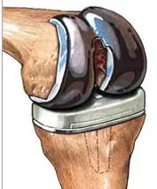 (courtesy:www.orthopedicsurgerybook.com)